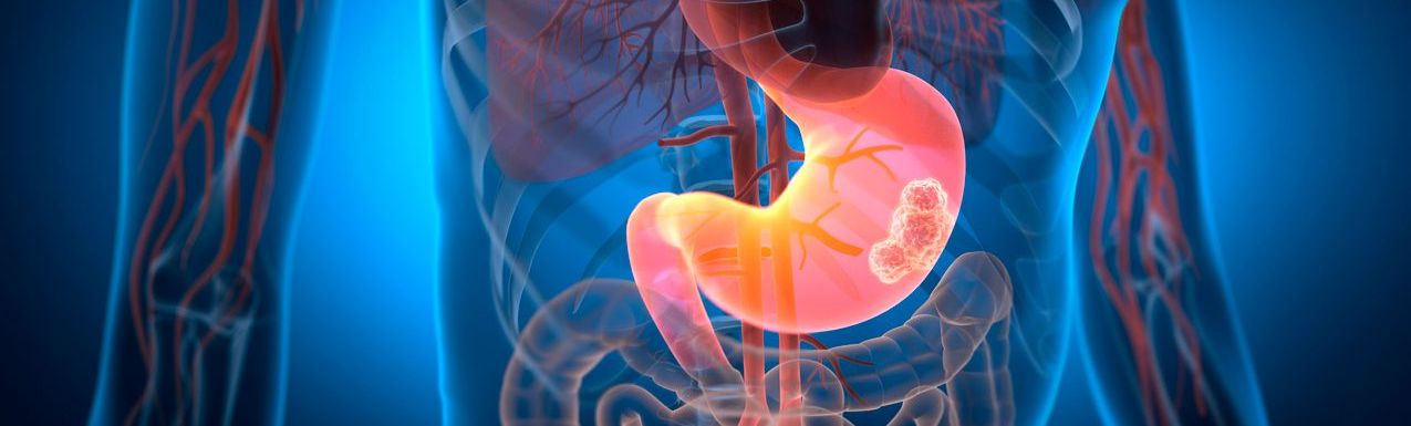 Cáncer gástrico GES: Conoce su cobertura y requisitos