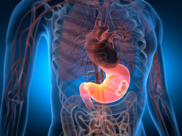 Cáncer gástrico GES: Conoce su cobertura y requisitos